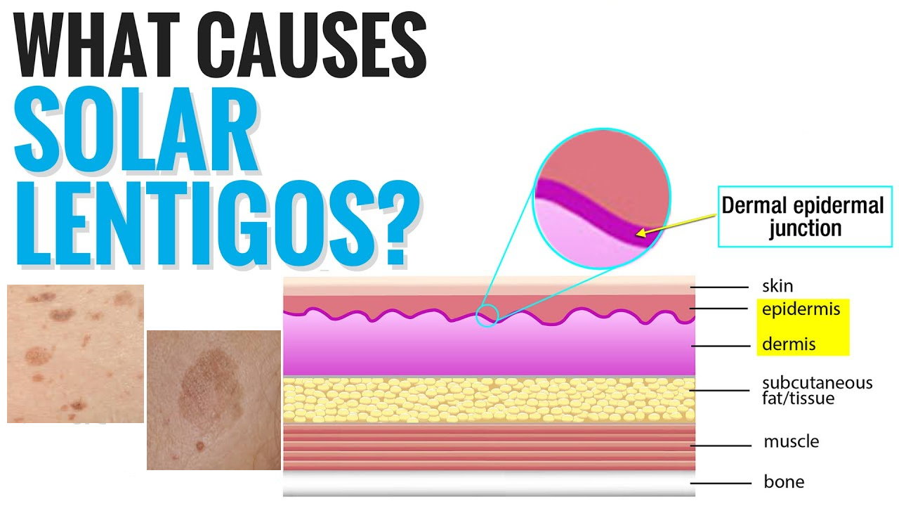 孚美达“氟轻松氢醌维A酸乳膏”能用于老年斑治疗吗？