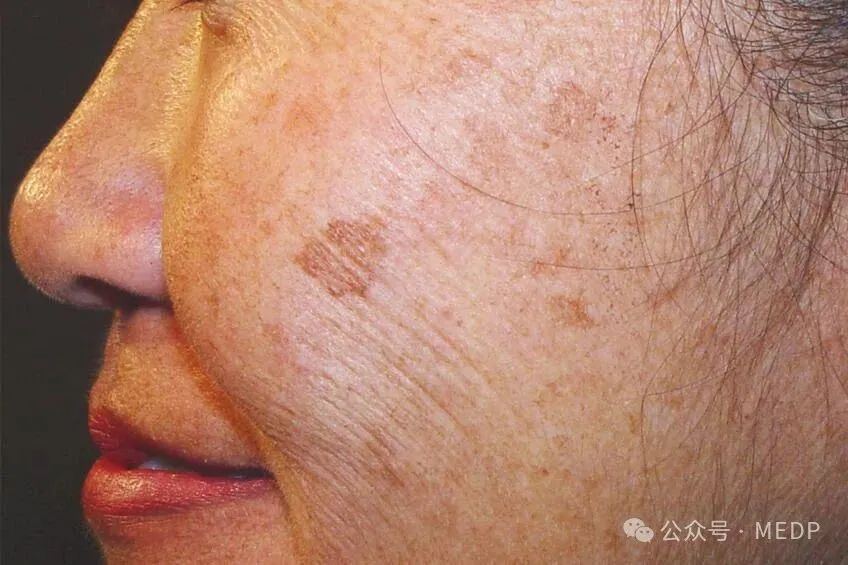 老年斑、晒斑、日光性雀斑是一回事吗？